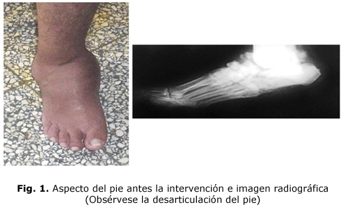 Fig. 1. Aspecto del pie antes la intervención e imagen radiográfica (Obsérvese la desarticulación del pie)