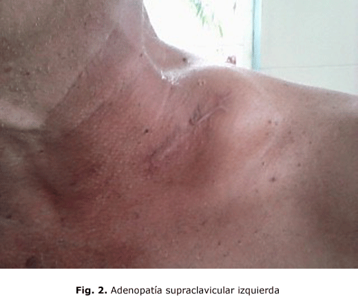 Fig. 2. Adenopatía supraclavicular izquierda