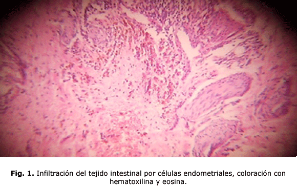 Fig. 1. Infiltración del tejido intestinal por células endometriales, coloración con hematoxilina y eosina.