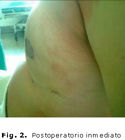 Fig. 2. Postoperatorio inmediato