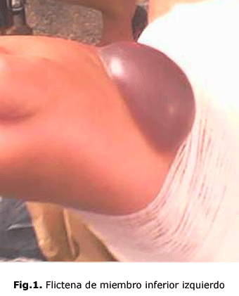 Fig.1. Flictena de miembro inferior izquierdo
