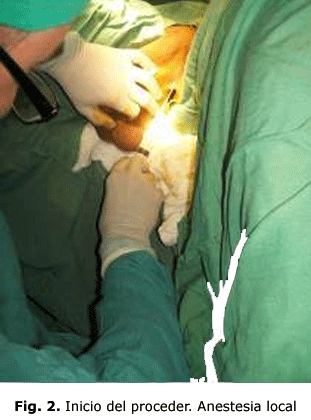 Fig. 2. Inicio del proceder. Anestesia local