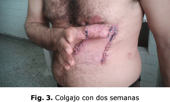 Fig. 3. Colgajo con dos semanas