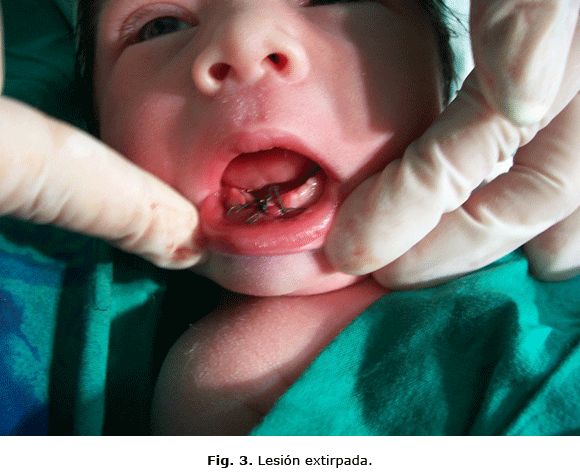 Fig. 3. Lesión extirpada.