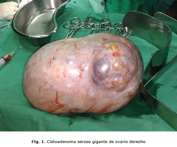 Fig. 1. Cistoadenoma seroso gigante de ovario derecho