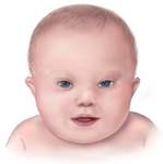 Descripción: Image Down_syndrome_lg