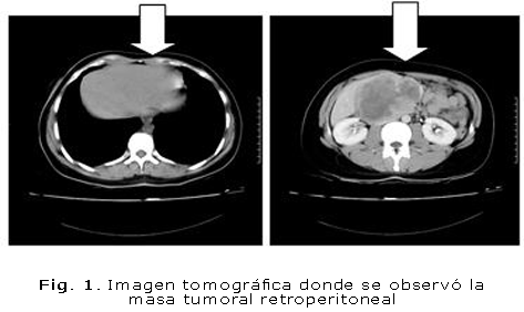 Fig. 1. Imagen tomográfica donde se observó la masa tumoral retroperitoneal