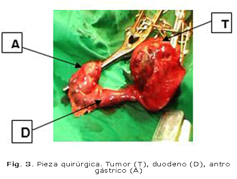 Fig. 3. Pieza quirúrgica. Tumor (T), duodeno (D), antro gástrico (A)