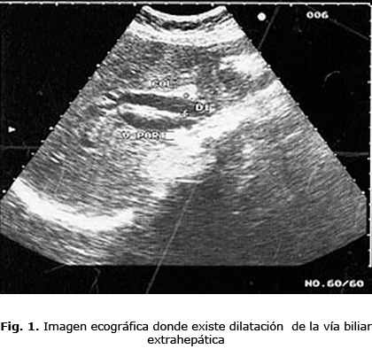 Fig. 1. Imagen ecográfica donde existe dilatación de la vía biliar
