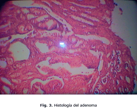 Fig. 3. Histología del adenoma