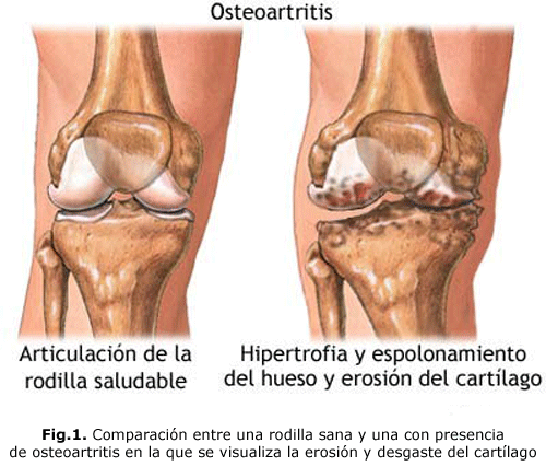 Fig.1. Comparación entre una rodilla sana y una con presencia de osteoartritis en la que se visualiza la erosión y desgaste del cartílago