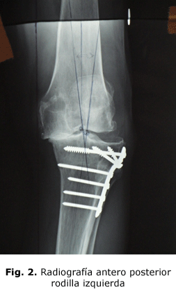 Fig. 2. Radiografía antero posterior rodilla izquierda
