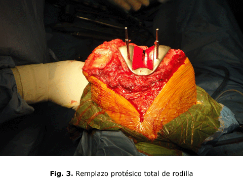 Fig. 3. Remplazo protésico total de rodilla