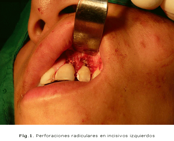 Fig.1. Perforaciones radiculares en incisivos izquierdos