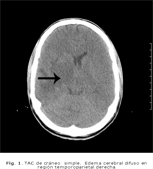 Fig. 1. TAC de cráneo simple. Edema cerebral difuso en región temporoparietal derecha