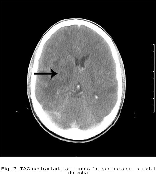 Fig. 2. TAC contrastada de cráneo. Imagen isodensa parietal derecha