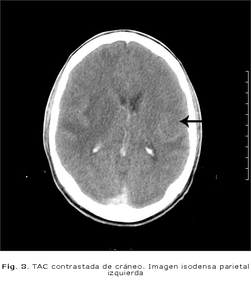Fig. 3. TAC contrastada de cráneo. Imagen isodensa parietal izquierda