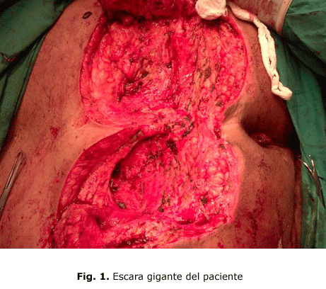 Fig. 1. Escara gigante del paciente