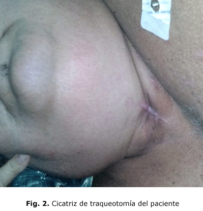 Fig. 2. Cicatriz de traqueotomía del paciente