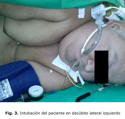 Fig. 3. Intubación del paciente en decúbito lateral izquierdo