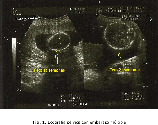 Fig. 1. Ecografía pélvica con embarazo múltiple