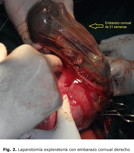 Fig. 2. Laparotomía exploratoria con embarazo cornual derecho