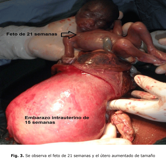 Fig. 3. Se observa el feto de 21 semanas y el útero aumentado de tamaño