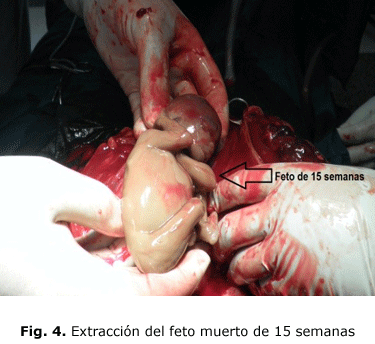Fig. 4. Extracción del feto muerto de 15 semanas