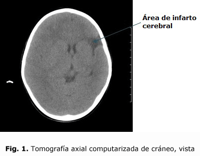 Fig. 1. Tomografía axial computarizada de cráneo, vista frontal