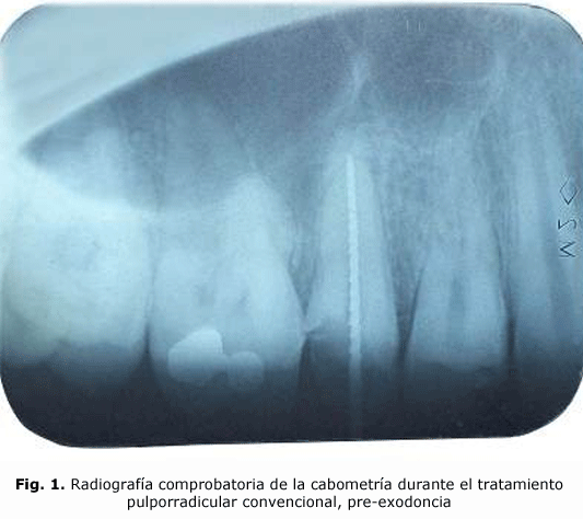 Fig. 1. Radiografía comprobatoria de la cabometría durante el tratamiento pulporradicular convencional, pre-exodoncia