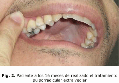 Fig. 2. Paciente a los 16 meses de realizado el tratamiento pulporradicular extralveolar