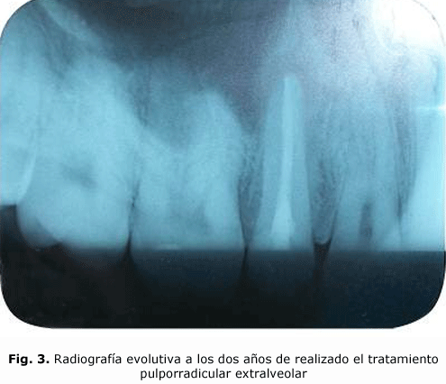 Fig. 3. Radiografía evolutiva a los dos años de realizado el tratamiento pulporradicular extralveolar