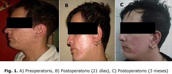 Fig. 1. A) Preoperatorio, B) Postoperatorio (21 días), C) Postoperatorio (3 meses)