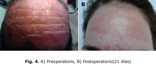 Fig. 4. A) Preoperatorio, B) Postoperatorio(21 días)