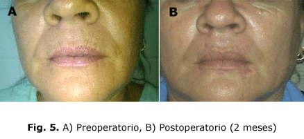 Fig. 5. A) Preoperatorio, B) Postoperatorio (2 meses)
