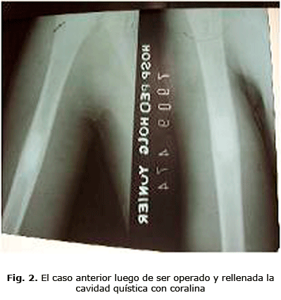 Fig. 2. El caso anterior luego de ser operado y rellenada la cavidad