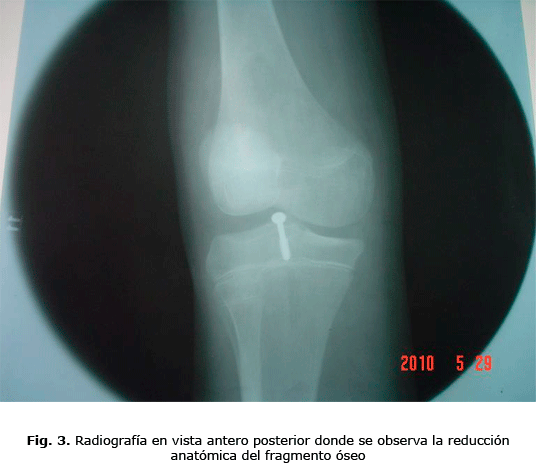 Fig. 3. Radiografía en vista antero posterior donde se observa la reducción anatómica del fragmento óseo