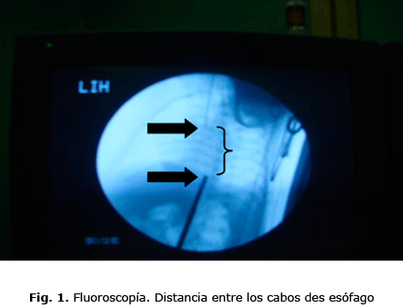 Fig. 1. Fluoroscopía. Distancia entre los cabos des esófago