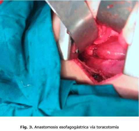 Fig. 3. Anastomosis esofagogástrica vía toracotomía