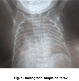 Fig. 1. Radiografía simple de tórax