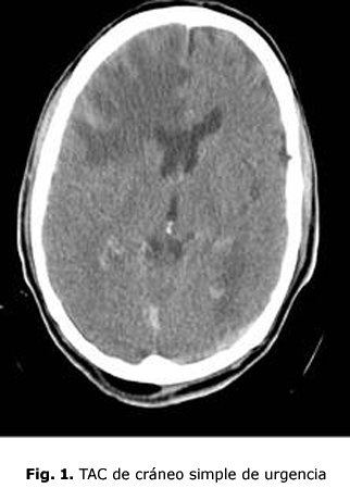 Fig.1 TAC de cráneo simple de urgencia