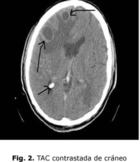 Fig. 2. TAC contrastada de cráneo