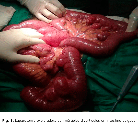 Fig. 1. Laparotomía exploradora con múltiples divertículos en intestino delgado
