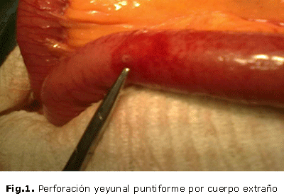 Fig.1. Perforación yeyunal puntiforme por cuerpo extraño