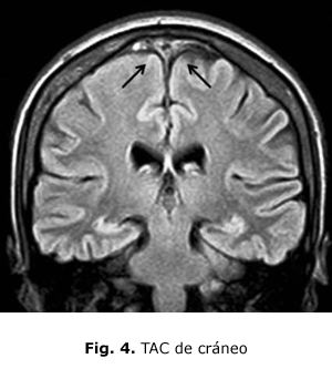 Fig. 4. TAC de cráneo