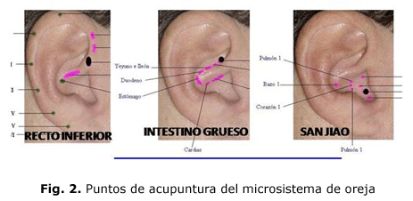 Fig. 2. Puntos de acupuntura del microsistema de oreja