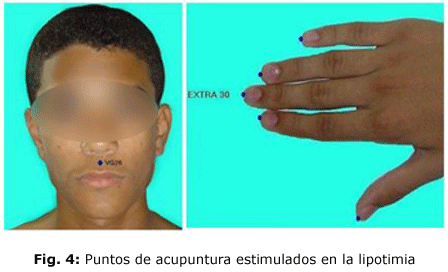 Fig. 4: Puntos de acupuntura estimulados en la lipotimia