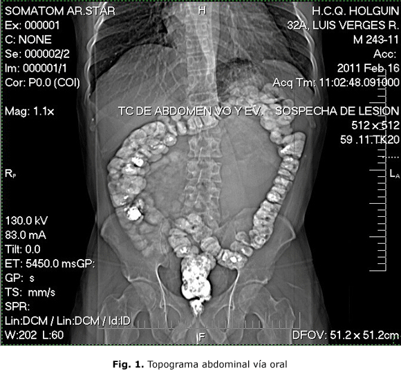 Fig. 1. Topograma abdominal vía oral