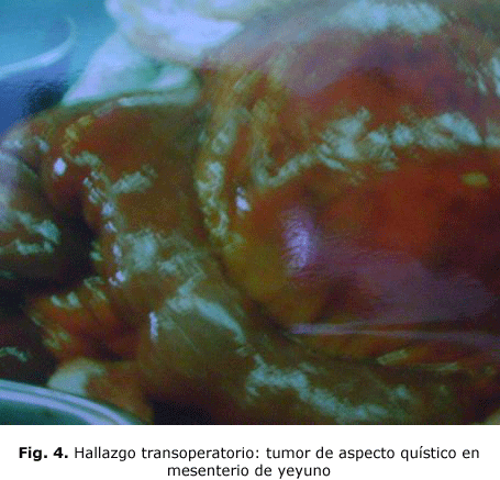 Fig. 4. Hallazgo transoperatorio: tumor de aspecto quístico en mesenterio de yeyuno