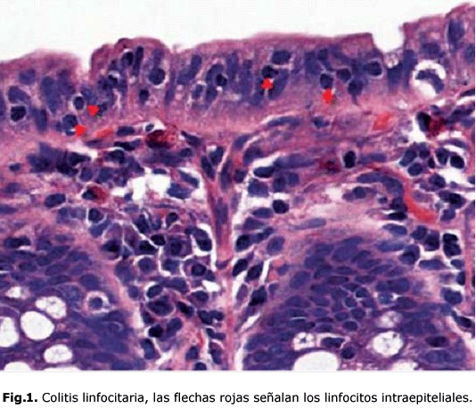 Fig.1. Colitis linfocitaria, las flechas rojas señalan los linfocitos intraepiteliales.